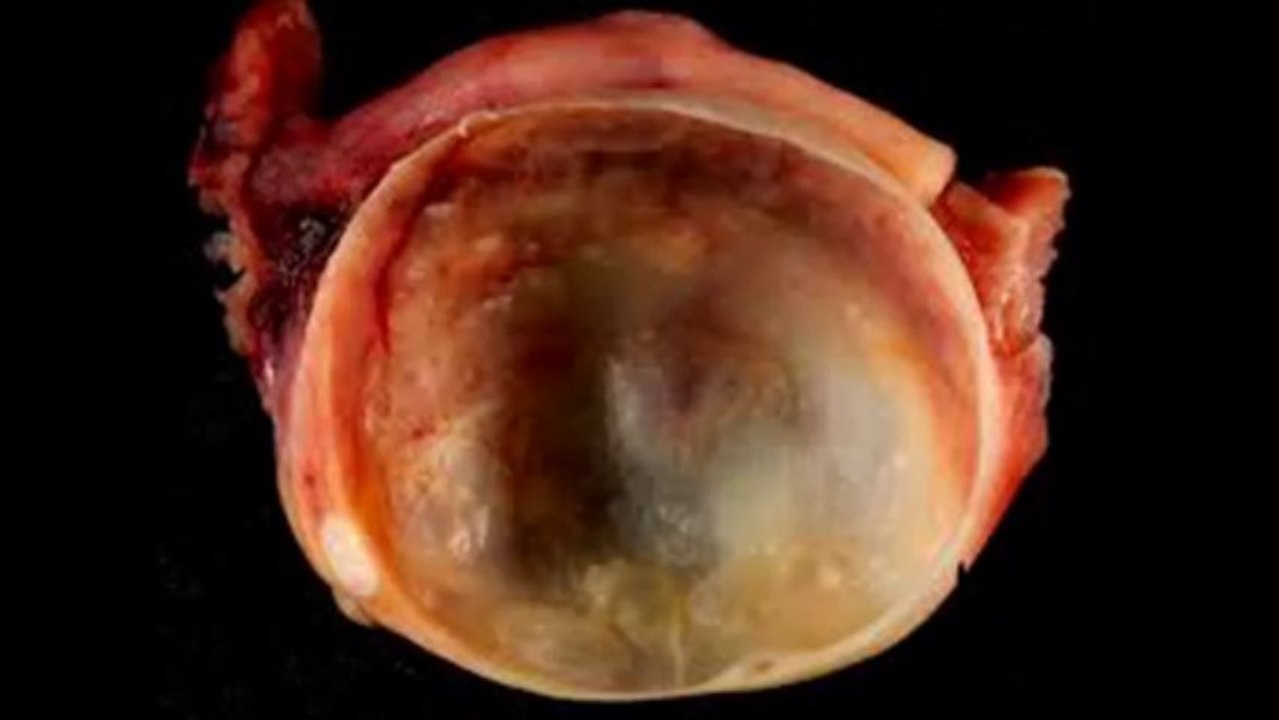 My Movie-cyst-on-ovary