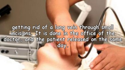 Facts About Varicose Veins Treatment NYC