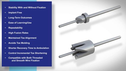 Fuse Right Hammertoe Solution