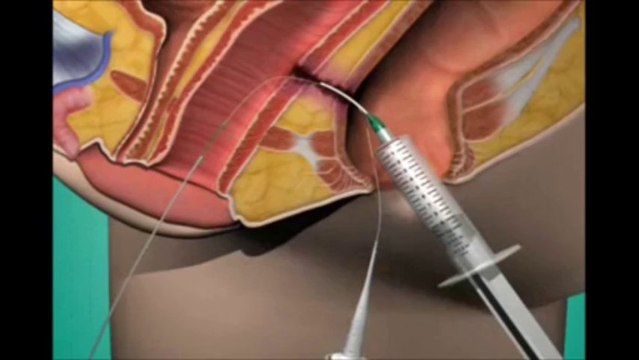 Fistula Treatment in Pune | Fistula Hospital in Pune | Dr. Ashwin Porwal - Fistula Surgeon Pune