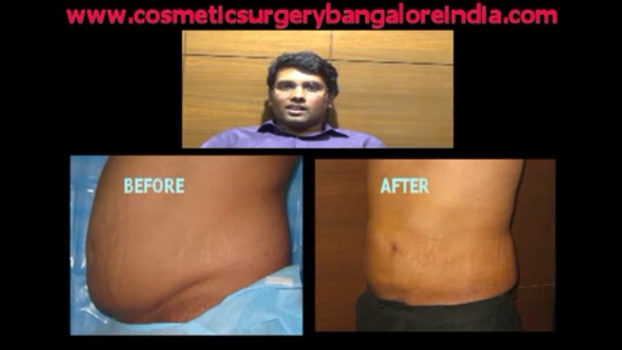 Liposuction, Bangalore, India