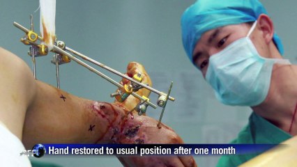 Chinese man's leg proves handy after accident