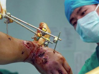 Médicos salvan la mano de un hombre "pegándola" a su tobillo