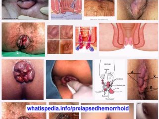 WHAT IS PROLAPSED HEMORRHOID whatispedia.info