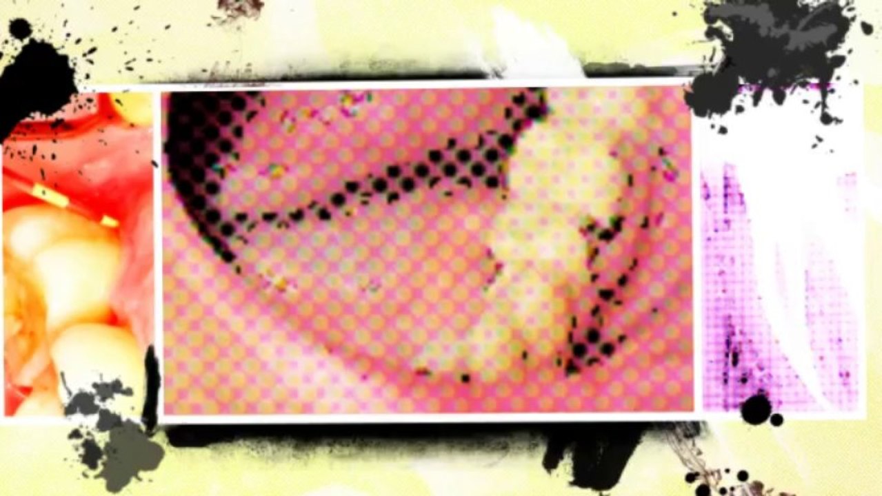 Root Canal Infection