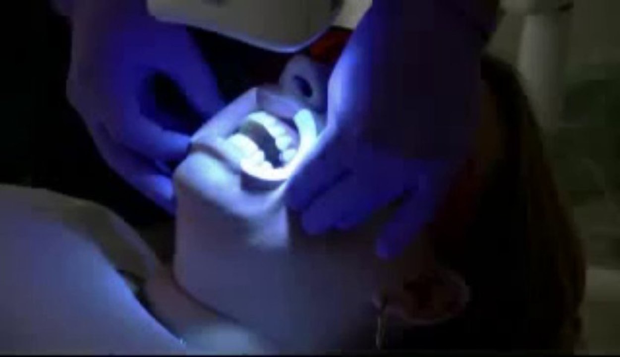 Sparkly Whites London Laser Teeth Whitening Clinic Treatment