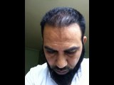 Best hair transplant in pakistan Lahore - www.fuepakistan.com