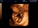 16 Haftalık Bebek Ultrason Görüntüsü
