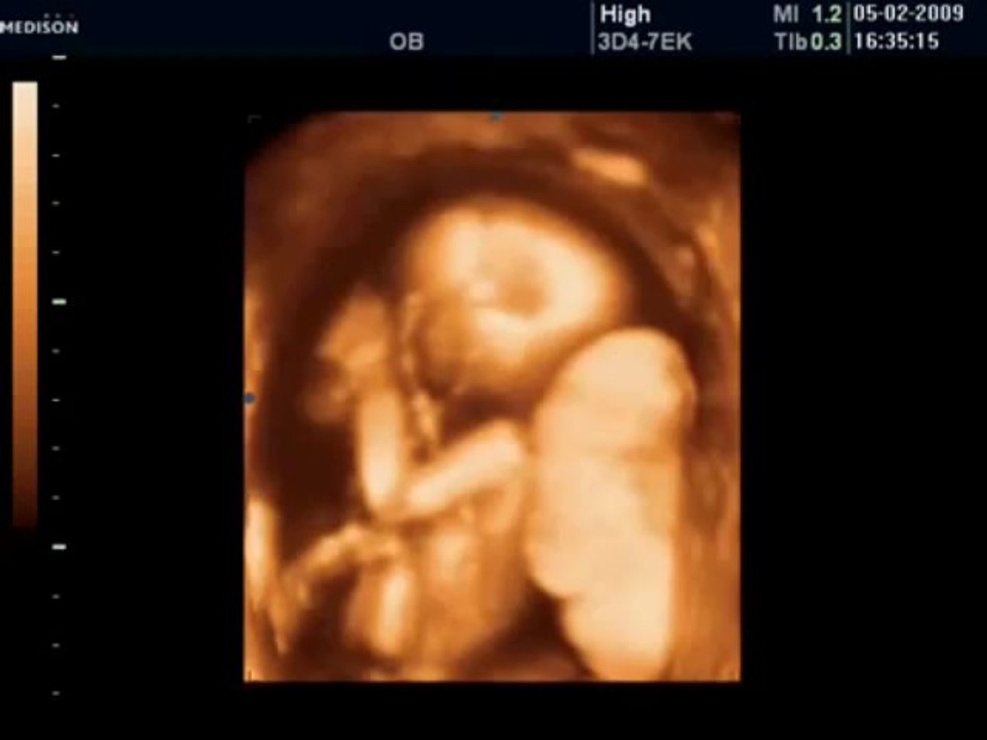 17 Haftalık Bebek Ultrason Görüntüsü - Dailymotion Video