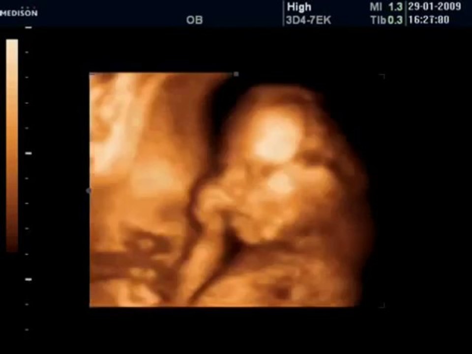 20 Haftalık Bebek Ultrason Görüntüsü - Dailymotion Video