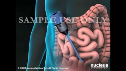 Laparscopic Inguinal Hernia Repair