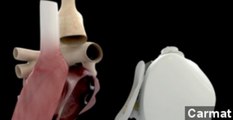 First Artificial Human Heart Transplant Performed In France
