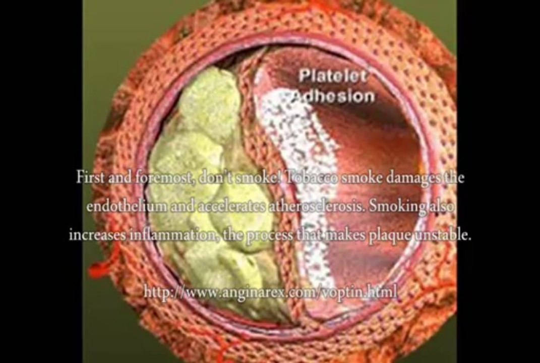 Remove Artery Plaque Buildup, How To Remove Artery Plaque Buildup Naturally