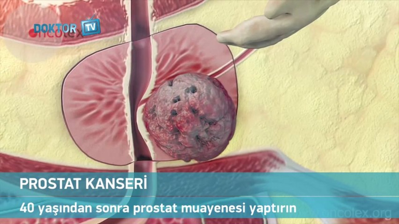 40 Yaşından Sonra Prostat Muayenesi Yaptırın