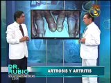 Soluciones Médicas: Conozca las diferencias entre la artrosis y artritis