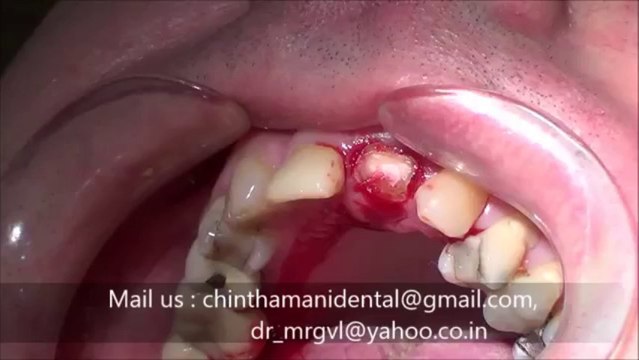 Accident front tooth fracture -extraction & immediate implant video 1