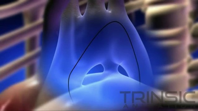 Concierge Catheter Medical Animation