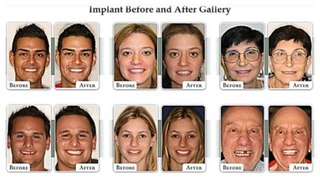 Dental implant || Dental Implant New York || Implant