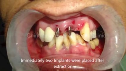 Dental Implants immediately after teeth extraction