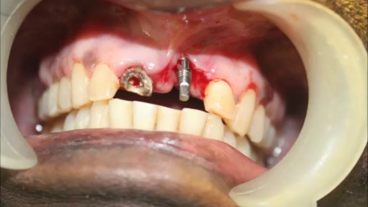 Failed Dental Bridge removed and replaced with dental implant!