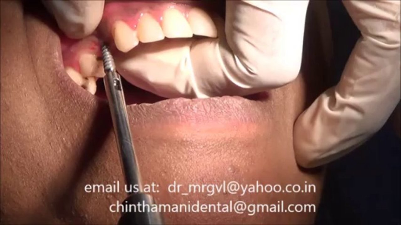 AFFORDABLE DENTAL IMPLANT IN CHENNAI