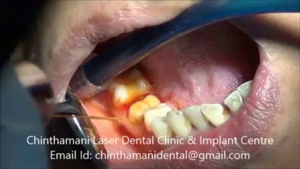 Gingival Troughing using Zolar Diode Laser in Chennai