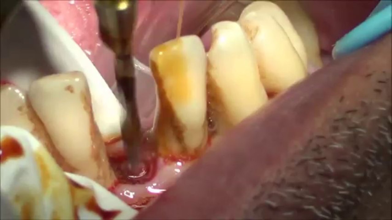 Happy patient reaction after dental implant placement in chennai,India