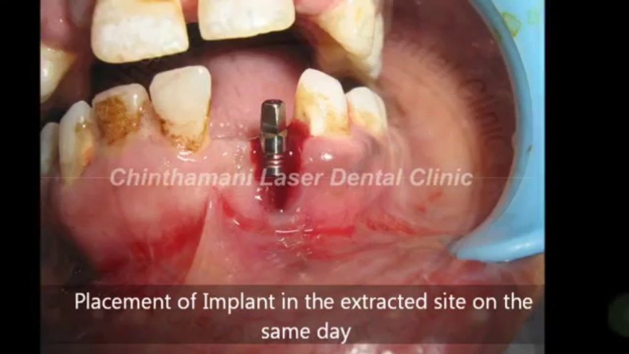 Immediate dental implant after extraction of mobile front tooth,Chennai.