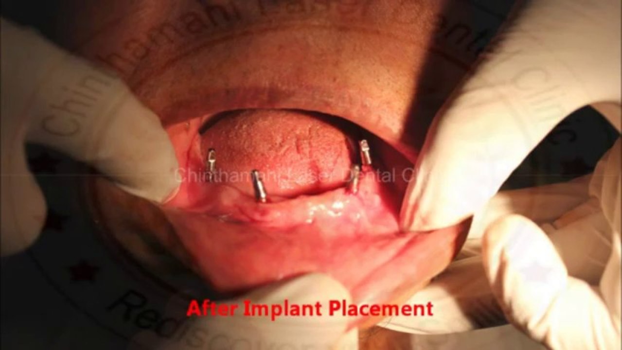 Loose Lower Denture Problem solved by Four BCS Implants,Chennai