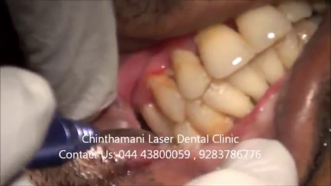 Laser Treatment (Video) for Oral submucous Fibrosis Part -1