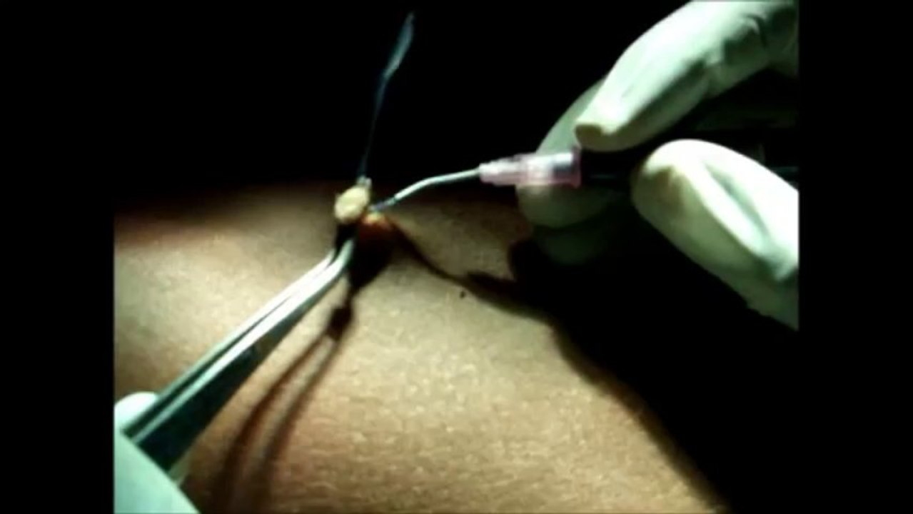 Laser Surgery for Wart