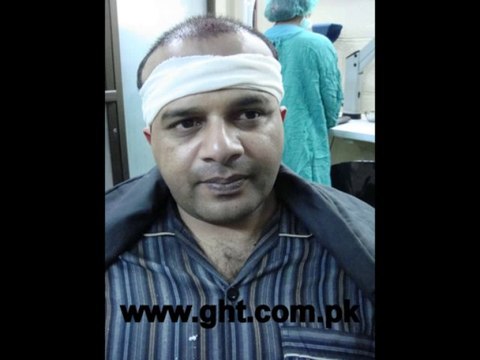 FUE hair transplant surgery,Gujrat Pakistan, fuepakistan.com