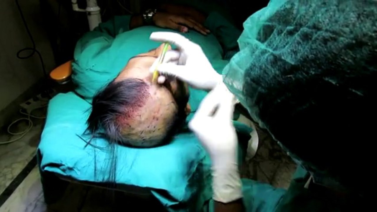 Synthetic Hair Transplant Surgery At Satya Hair Transplantation Clinic