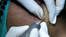 Follicular Unit Extraction (Fue) Hair Transplant Treatment for Hair Loss