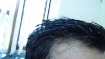 Hair Transplant in Delhi by Satya Hair Transplantation Clinic