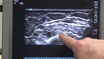 Ultrasonido Musculoesquelético - Queens NYC, Howard Beach, Ozone Park  - Benjamin Bieber, MD