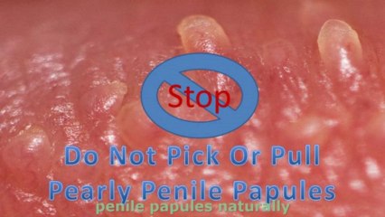 Papules Quick Fix Papules