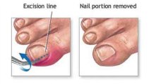 Ingrown Nail  - Podiatrist in Memphis, Shelby County and Mid-South TN
