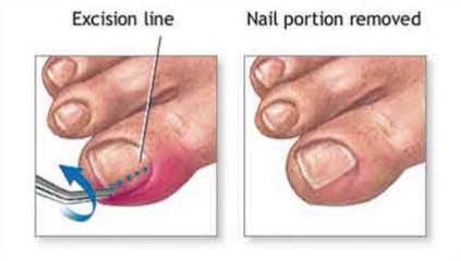 Ingrown Nail  - Podiatrist in Memphis, Shelby County and Mid-South TN