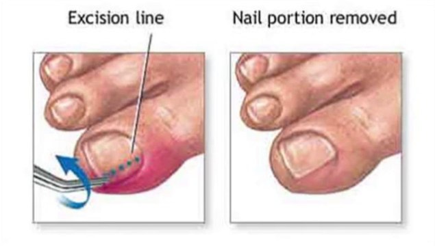 Ingrown Nail - Podiatrist in Memphis, Shelby County and Mid-South TN