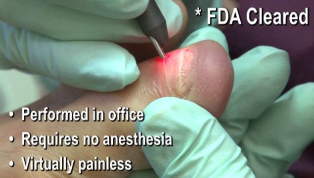 Laser Therapy for Fungal Toenails - Podiatrist in Memphis, Shelby County and Mid-South TN -