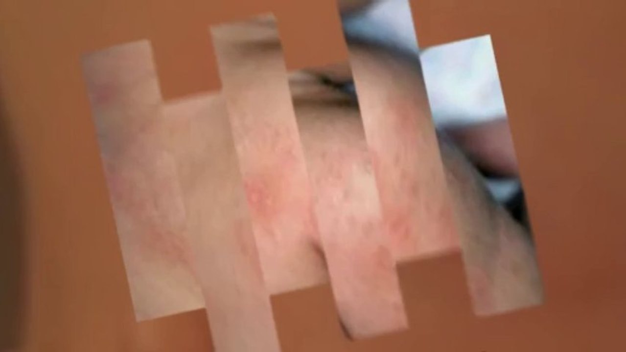 Rashes