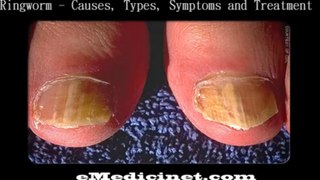 Ringworm - Causes, Types, Symptoms and Treatment - By eMedicinet.com - Part 1