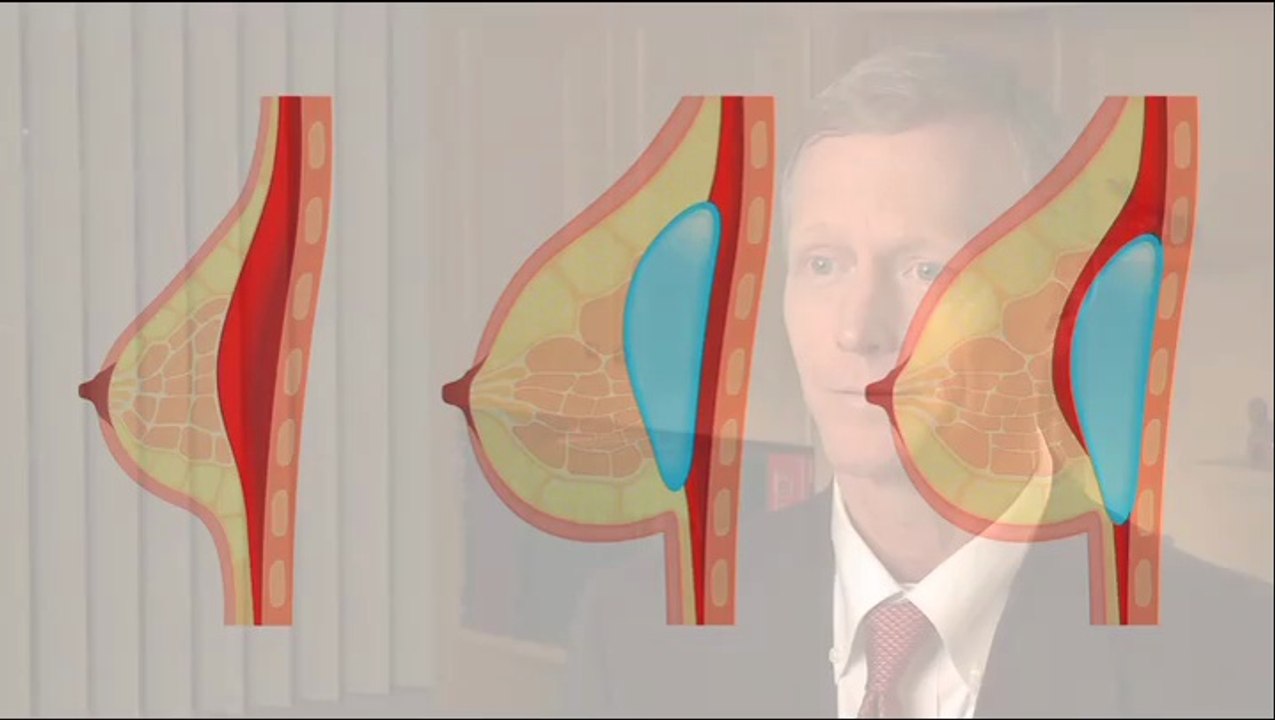 Mesna Plastic Surgery - Breast Augmentation