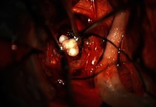 Doctors Remove Tumor In Baby's Brain And Find Teeth