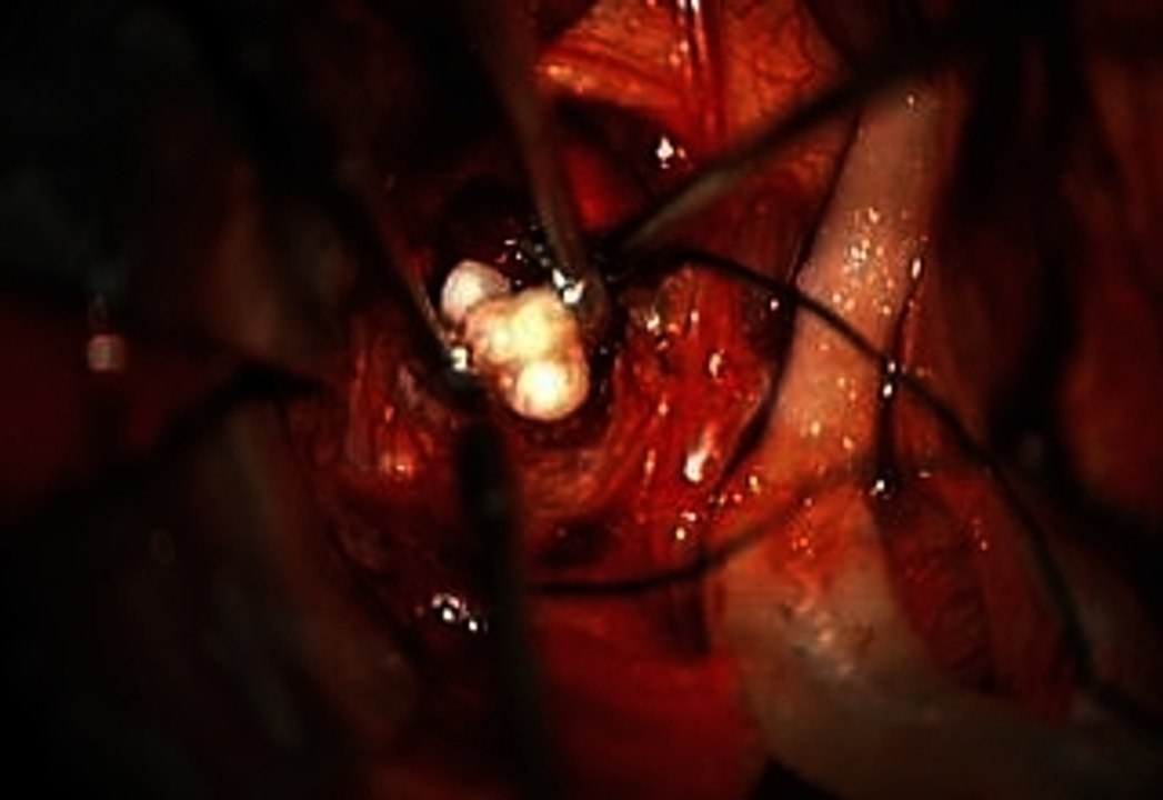 Doctors Remove Tumor In Baby's Brain And Find Teeth