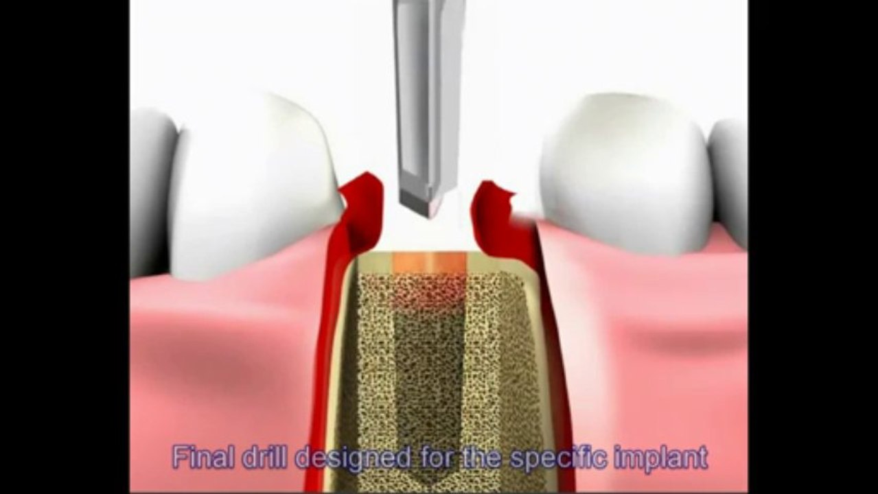 Dental implant procedure