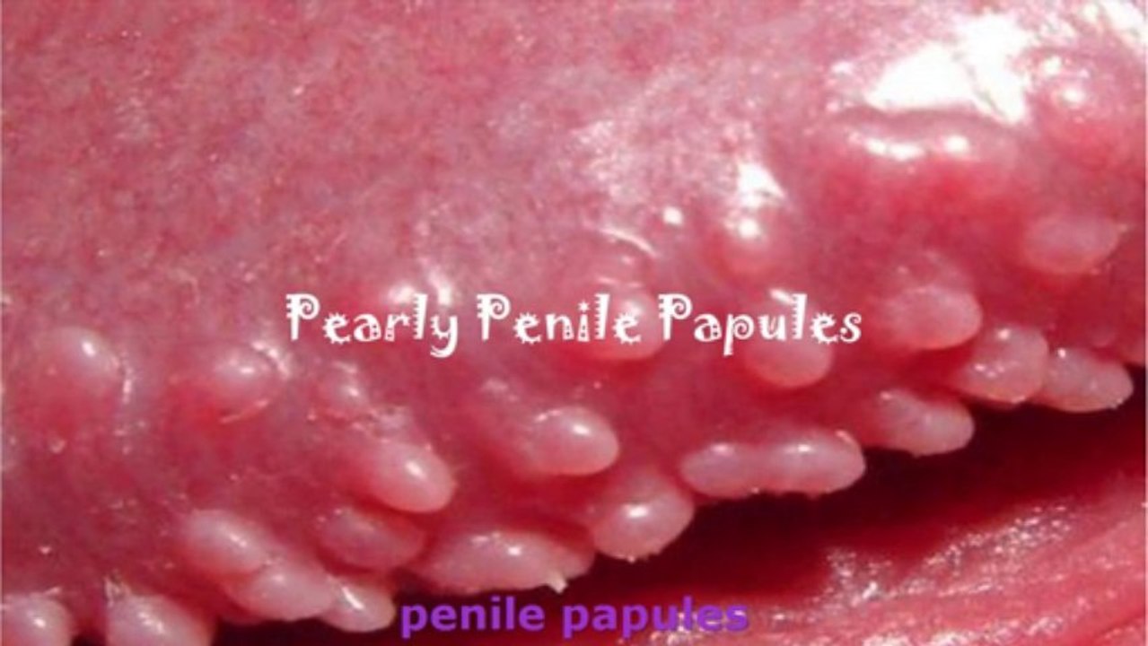 Penile papules tiny White Spots