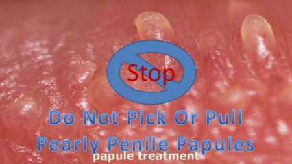 PPP Treatment Healing Agent PPP Treatment