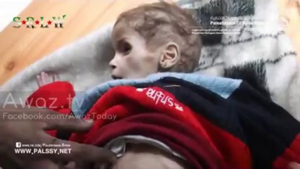 +18 SYRIA; The Palestinian child 'Alaa Al-Masri 'is facing death in Al-Yarmouk camp.